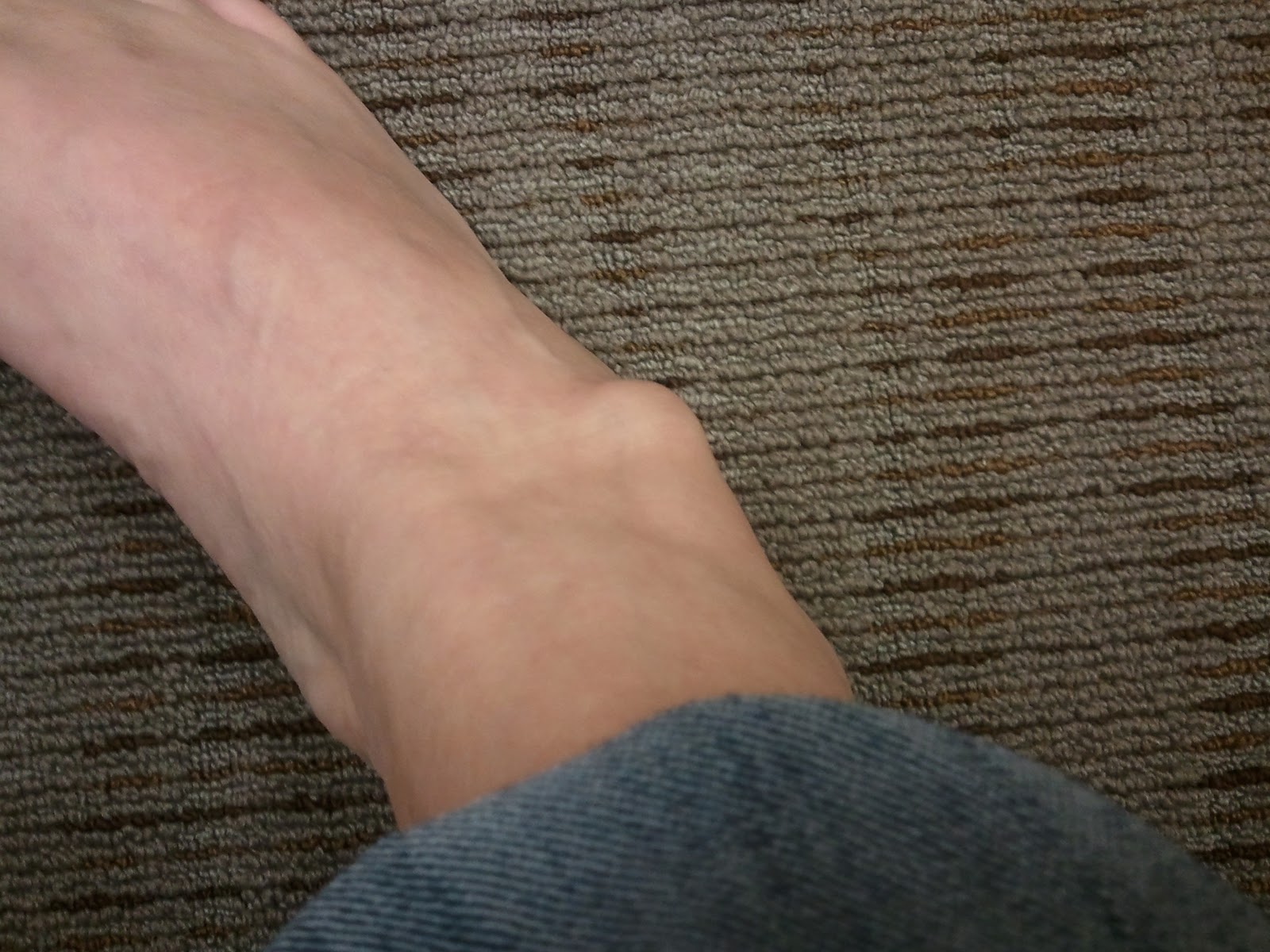 Why Do You Have Lump On Your Ankle MD Health