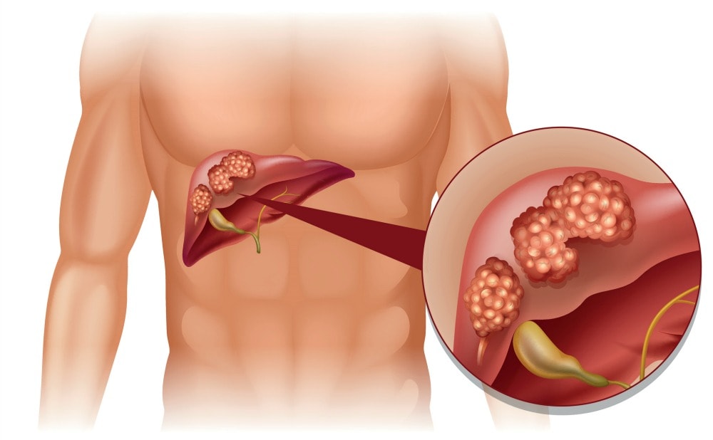 What Is Metastatic Liver Cancer MD Health