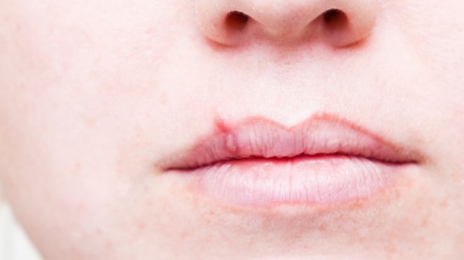 Cold Sore Causes Symptoms And Treatment MD Health