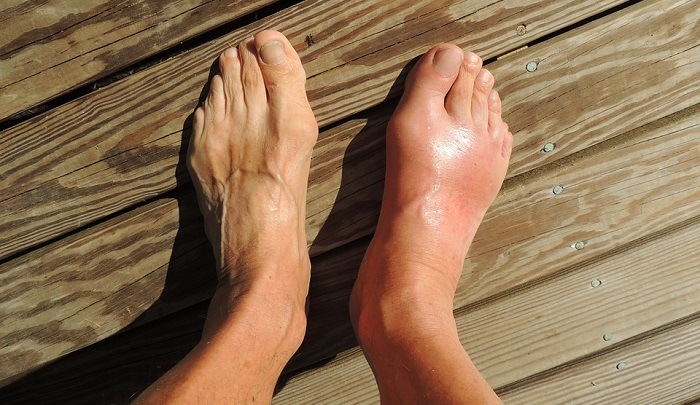 How To Deal With The Swelling Of The Top Of Your Foot MD Health