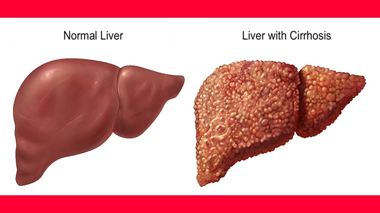 What Is The Life Expectancy Of Liver Cirrhosis MD Health