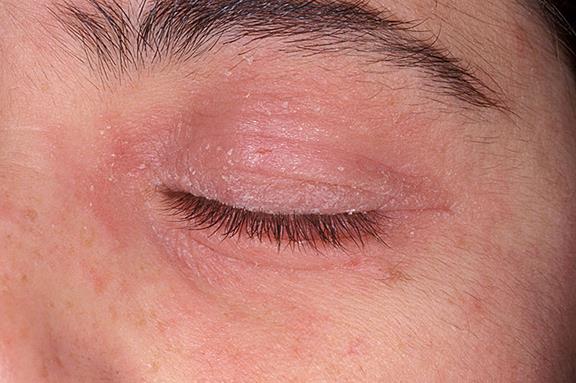 What Causes Itching Eyelids And How To Help MD Health