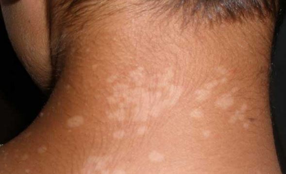 7 Common Causes Of White Spot On Your Skin MD Health