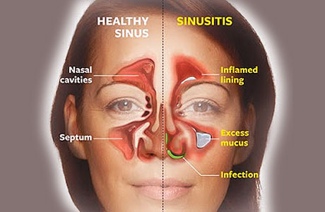 Symptoms Of Sinusitis And How To Get Relief New Health Advisor