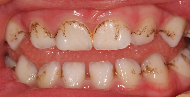 black-stains-on-the-teeth-major-causes-and-best-solutions-new-health