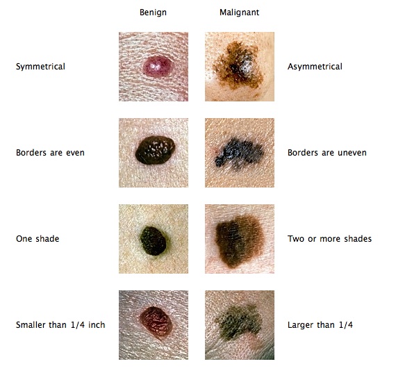 pics of cancerous skin tags