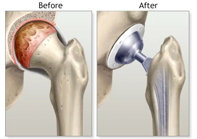 proper test fitness After Health.com MD  Tips Replacement Hip  and Precautions